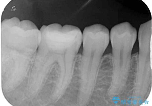 むし歯治療した歯にセラミックを入れたい セラミックインレー修復の治療後