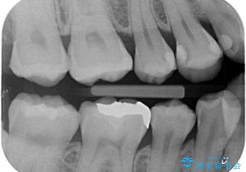 セラミック治療の治療前