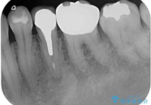 銀歯を白くしたい セラミックによる審美歯科治療の治療前