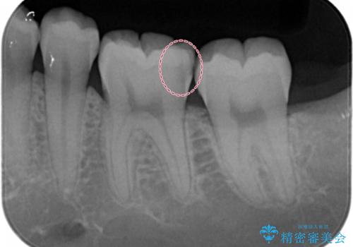 奥歯の虫歯 セラミックインレーによる治療
