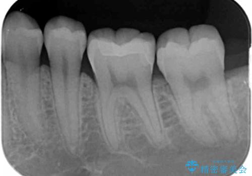 奥歯の虫歯　セラミックインレーによる治療の治療後