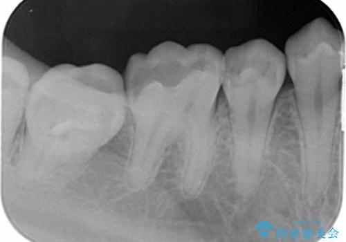 検査で見つかった虫歯　セラミックインレーでの修復の治療前
