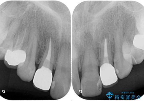 金属の見えてしまったクラウン セラミッククラウンで自然にの治療後