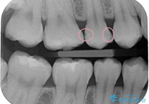 症状のない虫歯 セラミックインレーでの治療の治療前