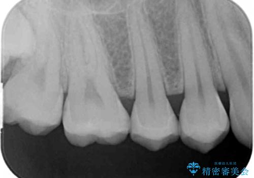 症状のない虫歯 セラミックインレーでの治療の治療後