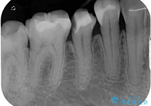 以前治療した詰め物が欠けた オールセラミッククラウンによる補綴の治療前