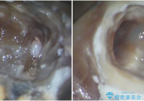奥歯の歯茎から膿が出る 根管治療とオールセラミッククラウンの治療中