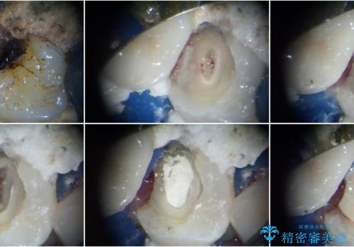 部分矯正を併用した奥歯のインプラント治療の治療中