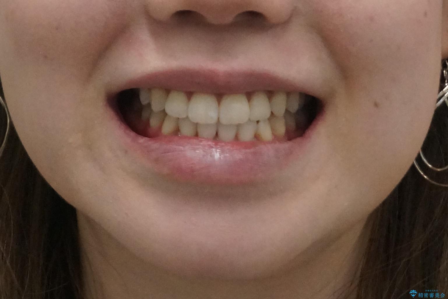 口元の印象が変わります。　引っ込んでいる前歯を出す治療の治療後（顔貌）
