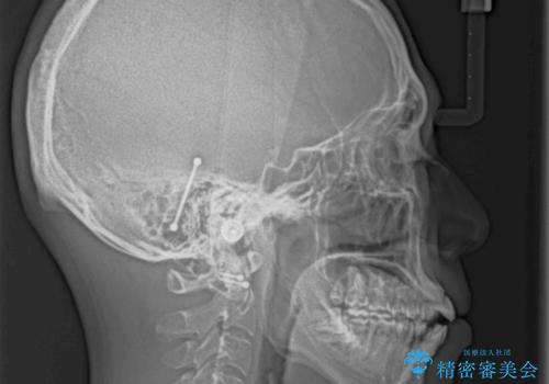 隙間が空いて突出した前歯を治したい ワイヤー装置による抜歯矯正の治療前