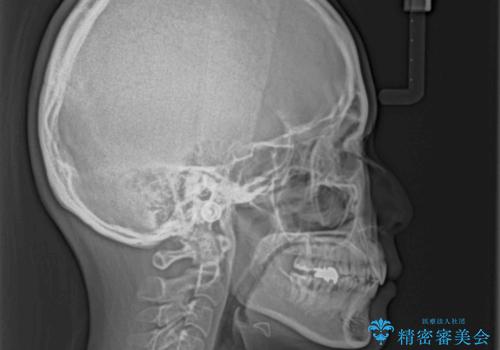 【モニター】口が閉じにくい　目立たないワイヤー装置で口元を引っ込めるの治療後