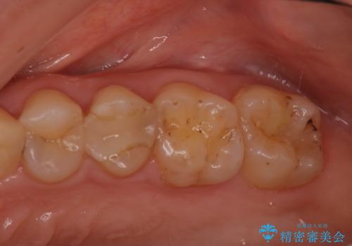 奥歯の着色が気になる セラミック治療の症例 治療前
