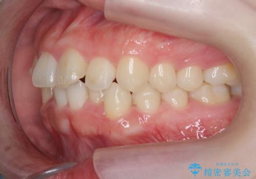 前歯の見た目を改善したいの治療中