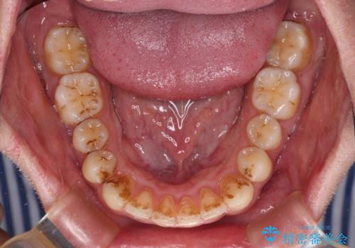前歯のデコボコをスッキリ改善　インビザライン矯正の治療中