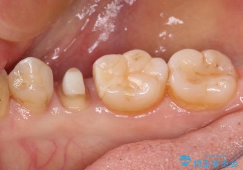以前治療した詰め物が欠けた オールセラミッククラウンによる補綴の治療中