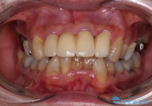 不具合ばかりの前歯　前歯のオールセラミックブリッジの治療後