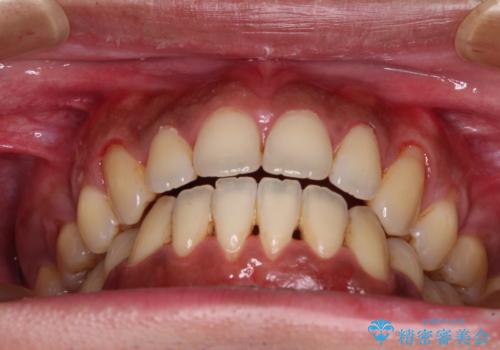隙間が空いて突出した前歯を治したい ワイヤー装置による抜歯矯正の治療後