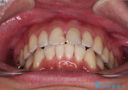 ワイヤー装置をインビザラインへ 装置変更での矯正治療の治療後