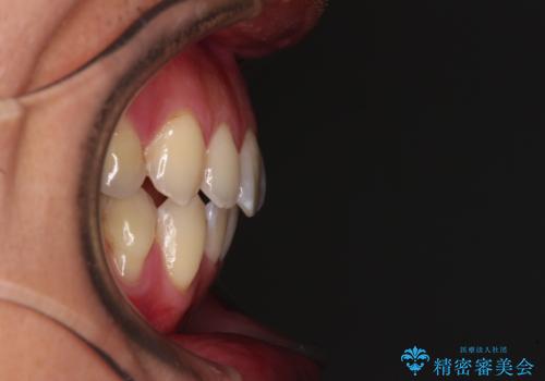 ワイヤー装置をインビザラインへ 装置変更での矯正治療の治療後