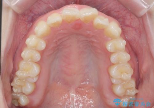 前歯の見た目を改善したいの治療中