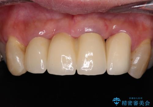 不具合ばかりの前歯　前歯のオールセラミックブリッジの症例 治療後