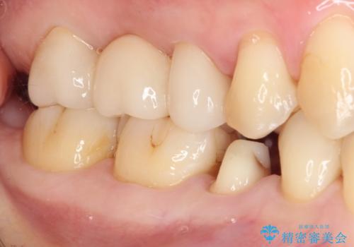 以前治療した詰め物が欠けた オールセラミッククラウンによる補綴の治療中