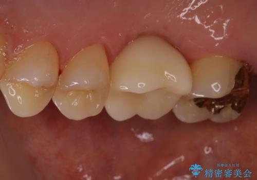 欠損している歯をインプラント治療により元のように咬めるようにの治療後