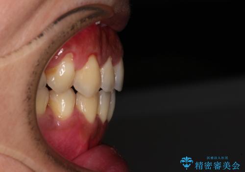隙間が空いて突出した前歯を治した　ワイヤー装置による抜歯矯正の治療後