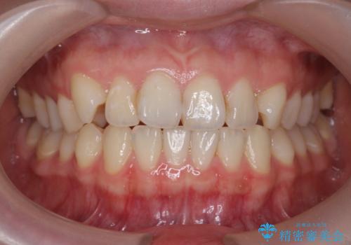 オフィスホワイトニングで歯の色を明るく!!の症例 治療前