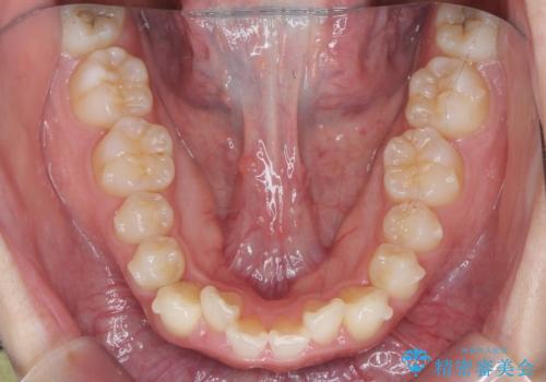 前歯の見た目を改善したいの治療中