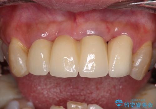 不具合ばかりの前歯 前歯のオールセラミックブリッジの治療後