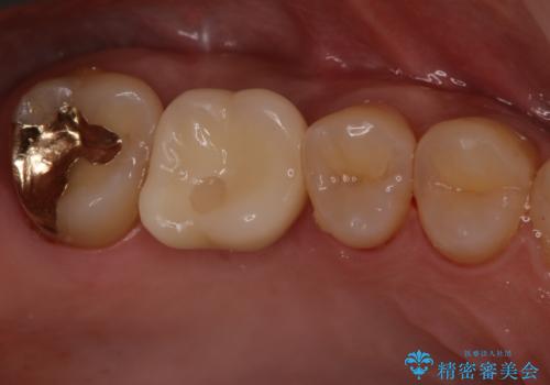 欠損している歯をインプラント治療により元のように咬めるようにの治療後