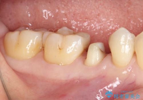 以前治療した詰め物が欠けた オールセラミッククラウンによる補綴の治療中