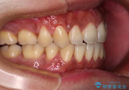 隙間が空いて突出した前歯を治したい ワイヤー装置による抜歯矯正の治療後