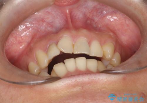 どこで咬めばいいかわからない 矯正治療で安定した咬み合わせにの治療前