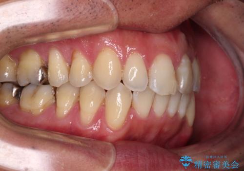 ワイヤー装置をインビザラインへ 装置変更での矯正治療の治療後