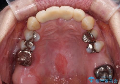 不具合ばかりの前歯　前歯のオールセラミックブリッジの治療後