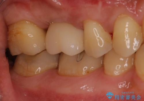 欠損している歯をインプラント治療により元のように咬めるようにの症例 治療後