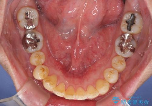 外側に飛び出した歯　インビザラインによる矯正治療の治療中