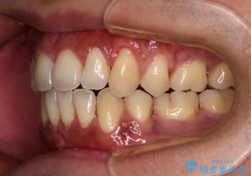 隙間が空いて突出した前歯を治したい ワイヤー装置による抜歯矯正の治療後