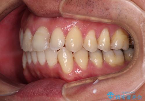 ワイヤー装置をインビザラインへ 装置変更での矯正治療の治療後