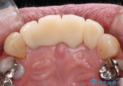 不具合ばかりの前歯 前歯のオールセラミックブリッジの治療後