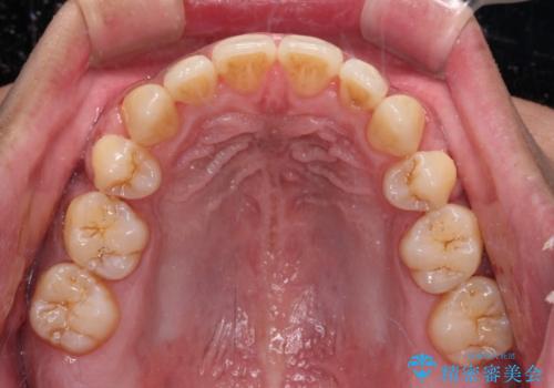 隙間が空いて突出した前歯を治したい ワイヤー装置による抜歯矯正の治療後
