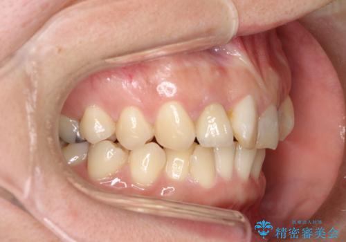 どこで咬めばいいかわからない 矯正治療で安定した咬み合わせにの治療前