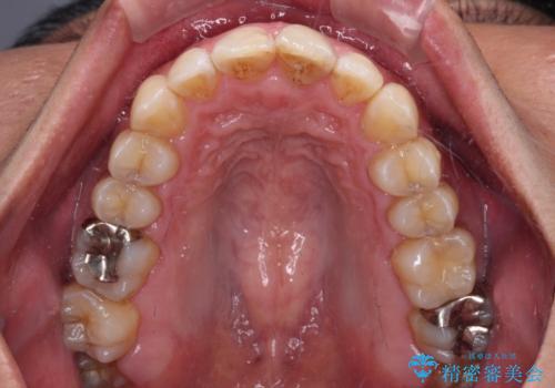 ワイヤー装置をインビザラインへ 装置変更での矯正治療の治療後