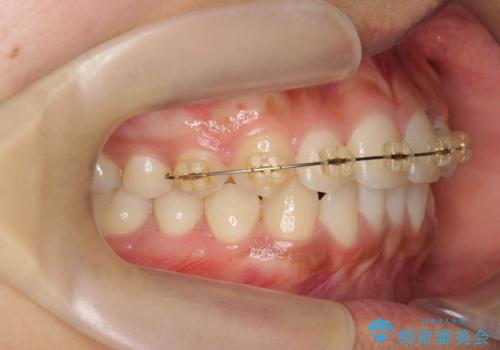 ワイヤー部分矯正を併用して治療期間を短縮 マウスピース矯正治療の治療中
