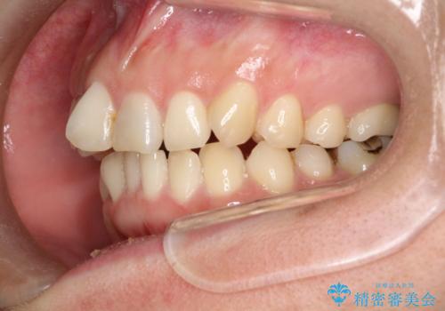 どこで咬めばいいかわからない 矯正治療で安定した咬み合わせにの治療前