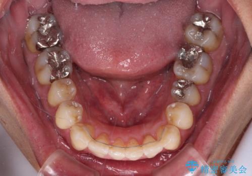 ワイヤー装置をインビザラインへ 装置変更での矯正治療の治療後
