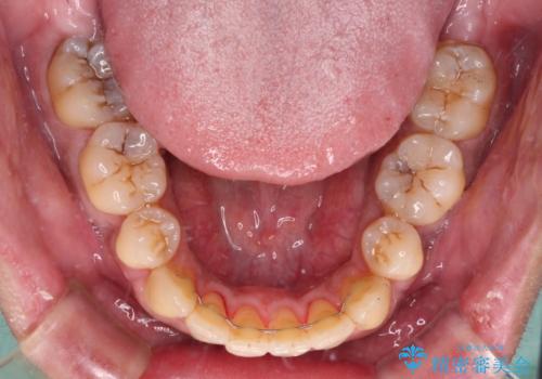 隙間が空いて突出した前歯を治したい ワイヤー装置による抜歯矯正の治療後