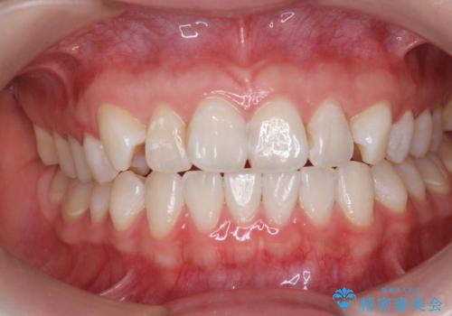 オフィスホワイトニングで歯の色を明るく!!